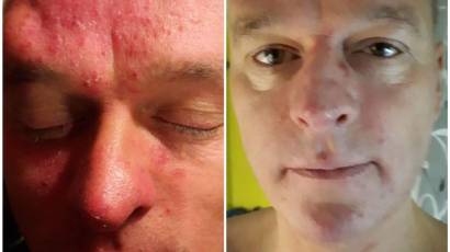 Plasma G rosacea kezelés plazmával Barta Edina