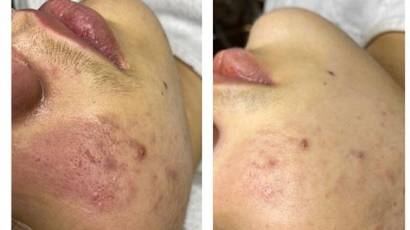 Plasma G aknés bőr kezelése plazmával Kőhalmi Luca