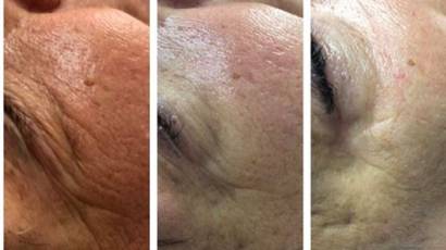 Plasma G anti-aging kezelés 3 funkcióval Kőhalmi Luca