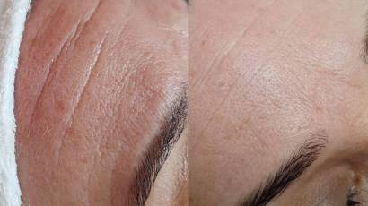 Plasma G anti-aging kezelés rádiófrekvenciával és plazmával Dunai Erika