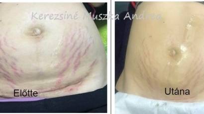 Plasma G stria kezelés, feszesítés rádiófrekvenciával és plazmával Kerezsiné Muszka Andrea