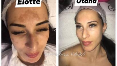 Plasma G anti-aging és pigmentkezelés rádiófrekvenciával és plazmával Kenyhercz Ildikó